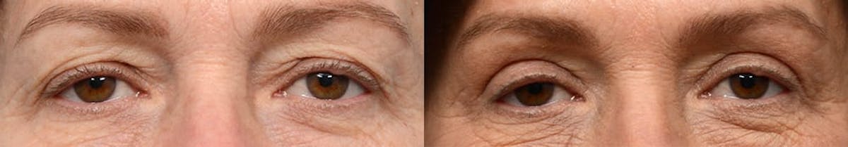 Blepharoplasty (Eyelid Surgery) Before & After Gallery - Patient 192011 - Image 1