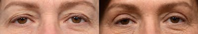 Blepharoplasty (Eyelid Surgery) Before & After Gallery - Patient 192011 - Image 1