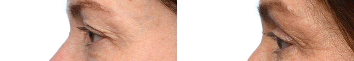 Blepharoplasty (Eyelid Surgery) Before & After Gallery - Patient 192011 - Image 2
