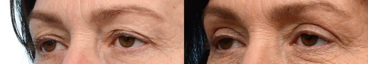 Blepharoplasty (Eyelid Surgery) Before & After Gallery - Patient 192011 - Image 3