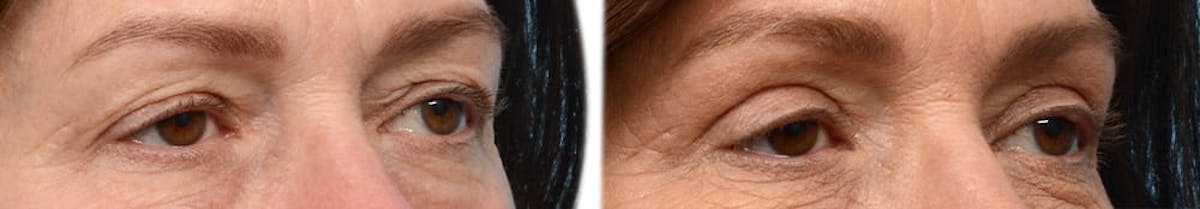 Blepharoplasty (Eyelid Surgery) Before & After Gallery - Patient 192011 - Image 5