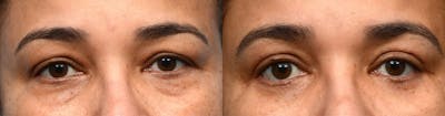 Blepharoplasty (Eyelid Surgery) Before & After Gallery - Patient 109414 - Image 1