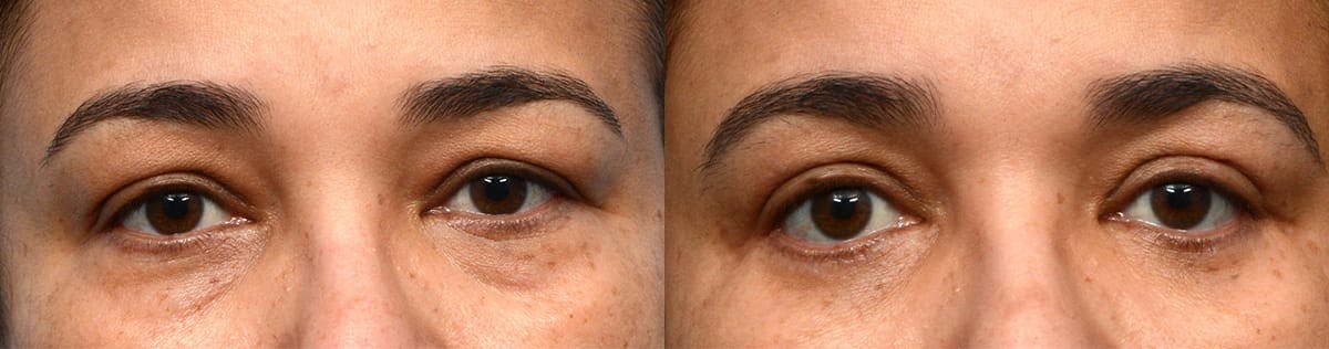 Blepharoplasty (Eyelid Surgery) Before & After Gallery - Patient 109414 - Image 1