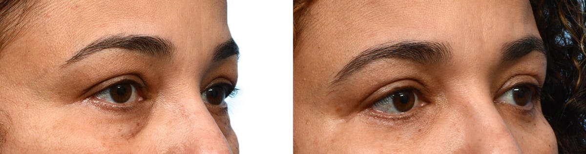 Blepharoplasty (Eyelid Surgery) Before & After Gallery - Patient 109414 - Image 2