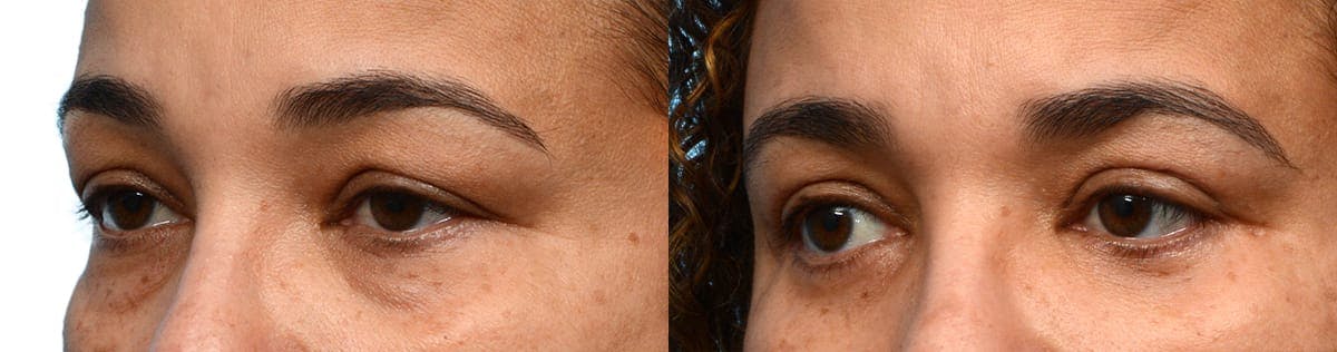 Blepharoplasty (Eyelid Surgery) Before & After Gallery - Patient 109414 - Image 3