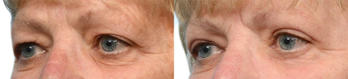 Blepharoplasty (Eyelid Surgery) Before & After Gallery - Patient 243905 - Image 1