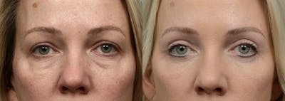 Blepharoplasty (Eyelid Surgery) Before & After Gallery - Patient 298099 - Image 1