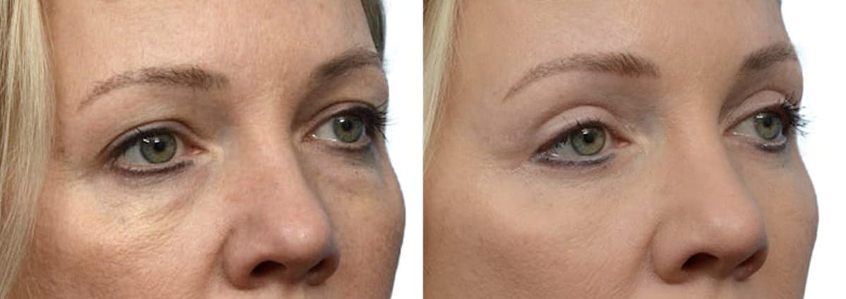 Blepharoplasty (Eyelid Surgery) Before & After Gallery - Patient 298099 - Image 2