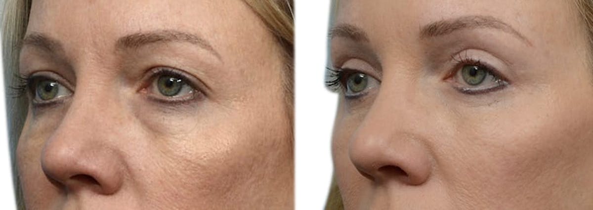 Blepharoplasty (Eyelid Surgery) Before & After Gallery - Patient 298099 - Image 3
