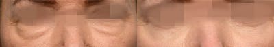 Blepharoplasty (Eyelid Surgery) Before & After Gallery - Patient 287304 - Image 1