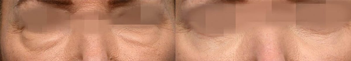 Blepharoplasty (Eyelid Surgery) Before & After Gallery - Patient 287304 - Image 1