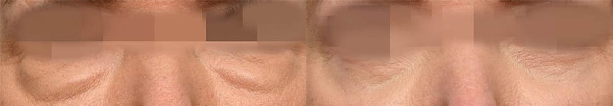 Blepharoplasty (Eyelid Surgery) Before & After Gallery - Patient 287304 - Image 2