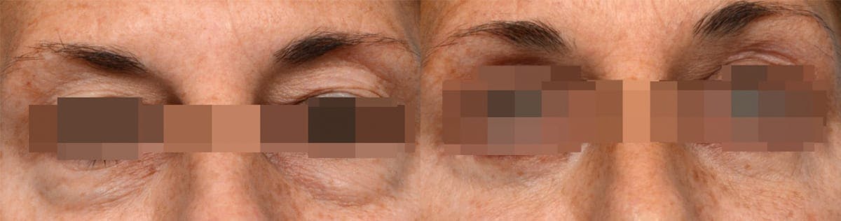 Blepharoplasty (Eyelid Surgery) Before & After Gallery - Patient 254883 - Image 1