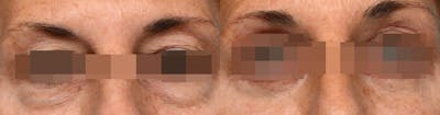 Blepharoplasty (Eyelid Surgery) Before & After Gallery - Patient 254883 - Image 1