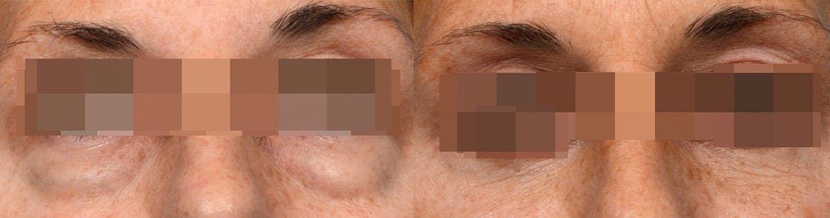 Blepharoplasty (Eyelid Surgery) Before & After Gallery - Patient 254883 - Image 2