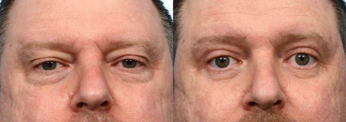 Blepharoplasty (Eyelid Surgery) Before & After Gallery - Patient 335128 - Image 1