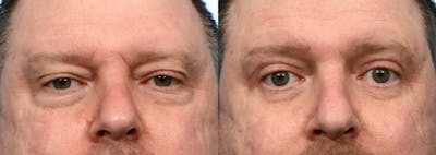 Blepharoplasty (Eyelid Surgery) Before & After Gallery - Patient 335128 - Image 1