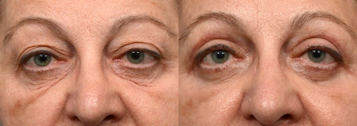 Blepharoplasty (Eyelid Surgery) Before & After Gallery - Patient 973569 - Image 1