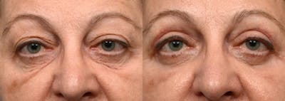 Blepharoplasty (Eyelid Surgery) Before & After Gallery - Patient 973569 - Image 1