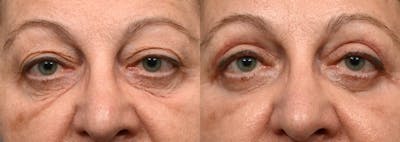 Blepharoplasty (Eyelid Surgery) Before & After Gallery - Patient 973569 - Image 1