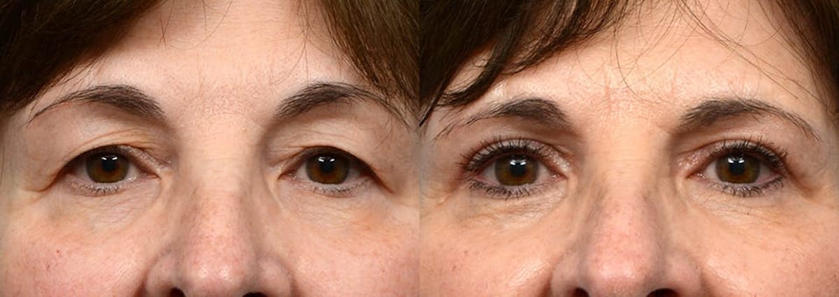 Blepharoplasty (Eyelid Surgery) Before & After Gallery - Patient 337235 - Image 1