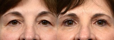 Blepharoplasty (Eyelid Surgery) Before & After Gallery - Patient 337235 - Image 1