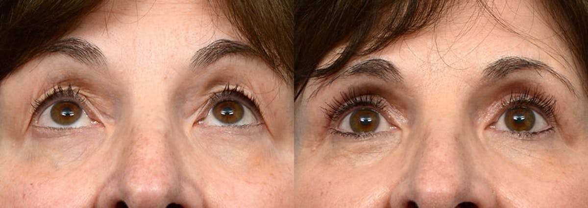 Blepharoplasty (Eyelid Surgery) Before & After Gallery - Patient 337235 - Image 2