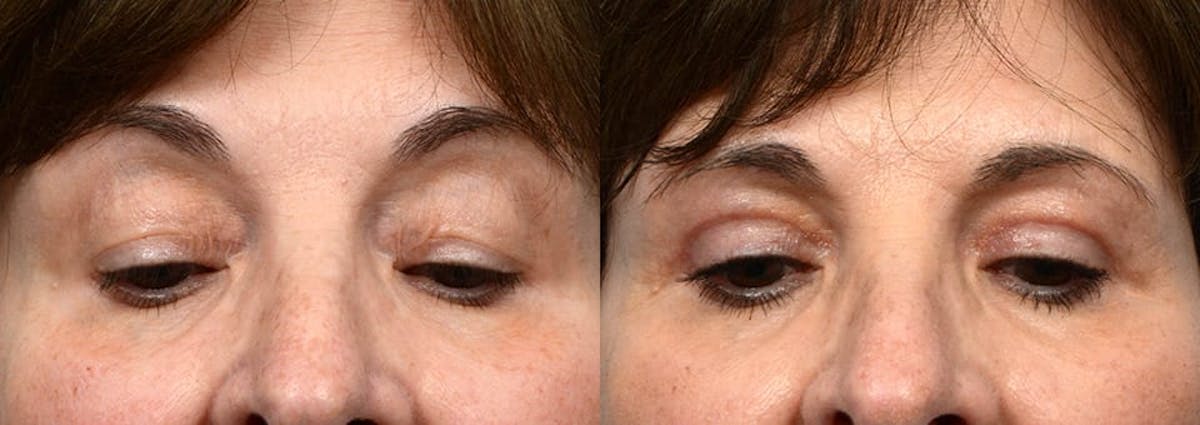 Blepharoplasty (Eyelid Surgery) Before & After Gallery - Patient 337235 - Image 3