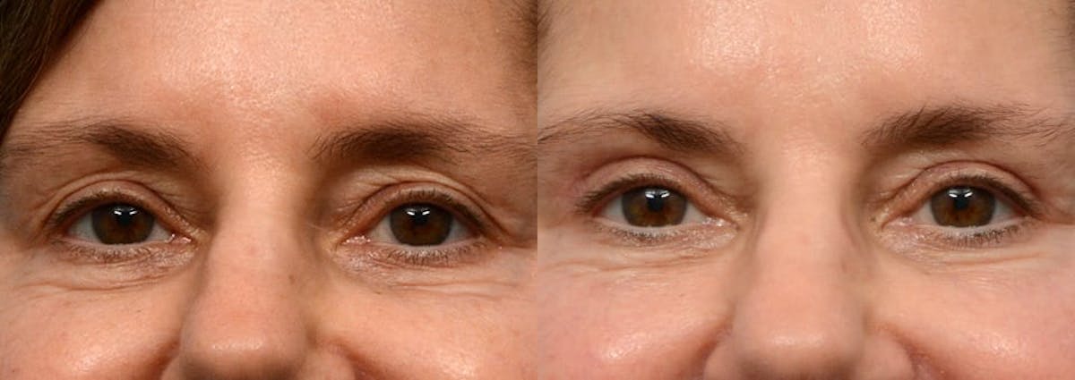 Blepharoplasty (Eyelid Surgery) Before & After Gallery - Patient 318079 - Image 1