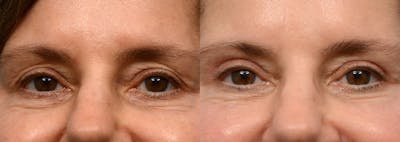 Blepharoplasty (Eyelid Surgery) Before & After Gallery - Patient 318079 - Image 1