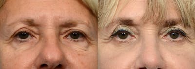 Blepharoplasty (Eyelid Surgery) Before & After Gallery - Patient 265182 - Image 1