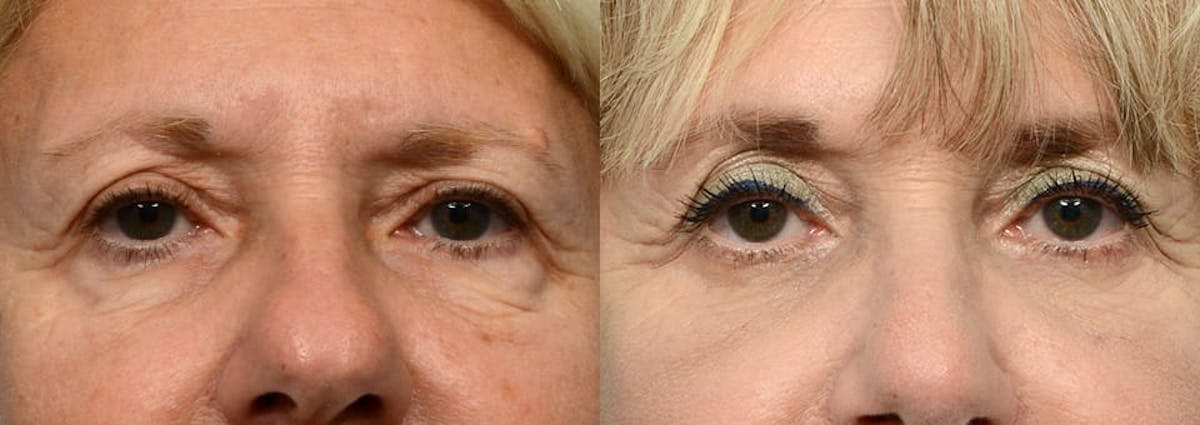 Blepharoplasty (Eyelid Surgery) Before & After Gallery - Patient 265182 - Image 1