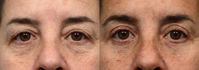 Blepharoplasty (Eyelid Surgery) Before & After Gallery - Patient 736376 - Image 1