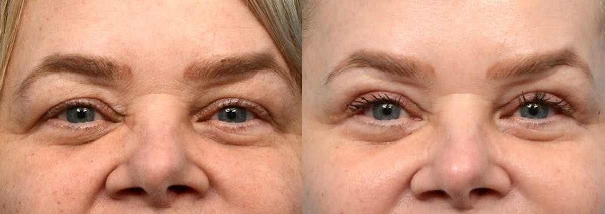 Blepharoplasty (Eyelid Surgery) Before & After Gallery - Patient 452589 - Image 1