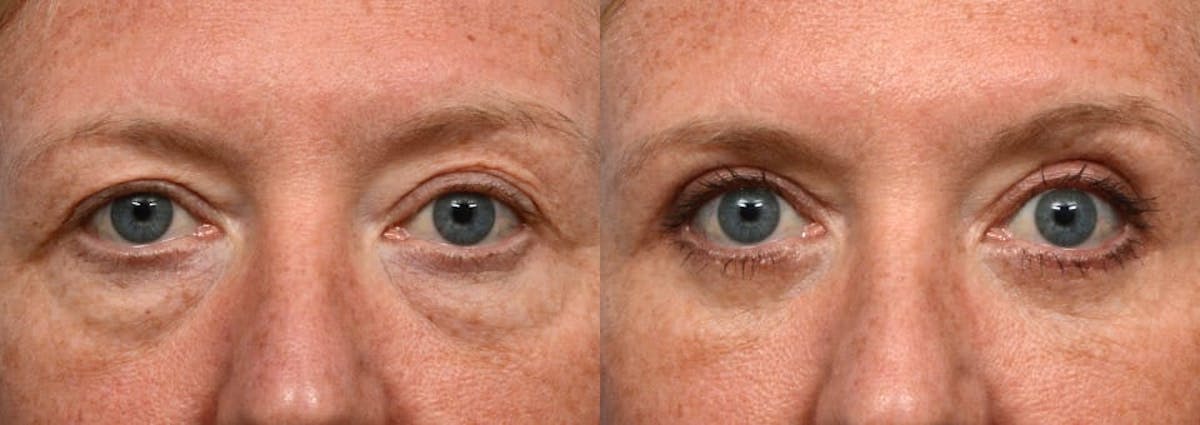 Blepharoplasty (Eyelid Surgery) Before & After Gallery - Patient 294176 - Image 1