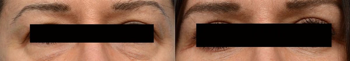 Blepharoplasty (Eyelid Surgery) Before & After Gallery - Patient 778368 - Image 1