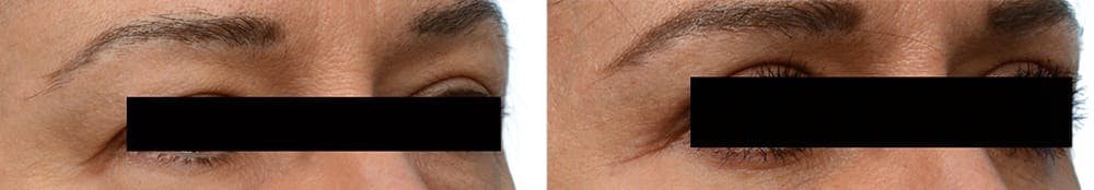 Blepharoplasty (Eyelid Surgery) Before & After Gallery - Patient 778368 - Image 2