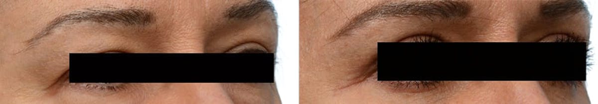 Blepharoplasty (Eyelid Surgery) Before & After Gallery - Patient 778368 - Image 2