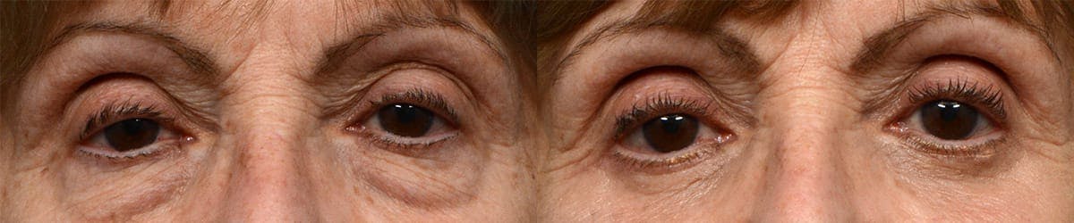 Blepharoplasty (Eyelid Surgery) Before & After Gallery - Patient 622381 - Image 1