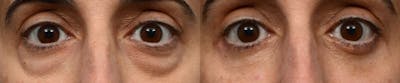 Blepharoplasty (Eyelid Surgery) Before & After Gallery - Patient 712045 - Image 1