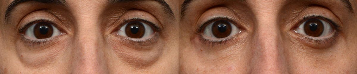 Blepharoplasty (Eyelid Surgery) Before & After Gallery - Patient 712045 - Image 1