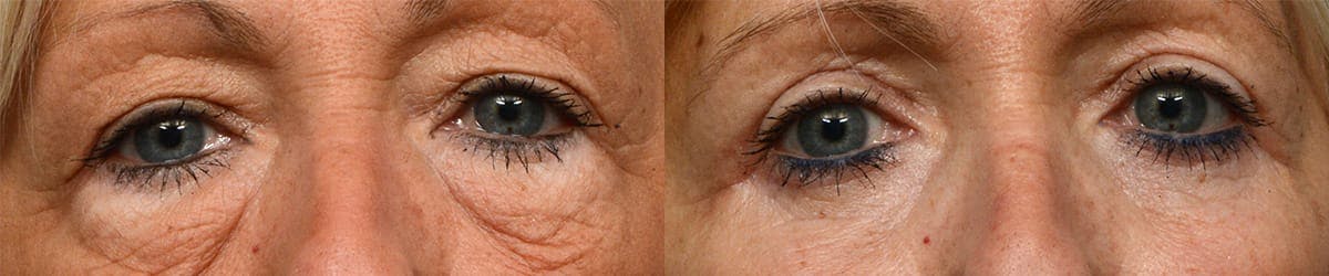 Blepharoplasty (Eyelid Surgery) Before & After Gallery - Patient 174671 - Image 1