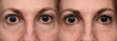 Blepharoplasty (Eyelid Surgery) Before & After Gallery - Patient 348036 - Image 1