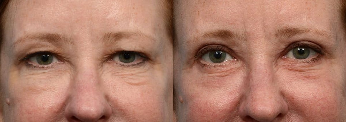 Blepharoplasty (Eyelid Surgery) Before & After Gallery - Patient 242875 - Image 1