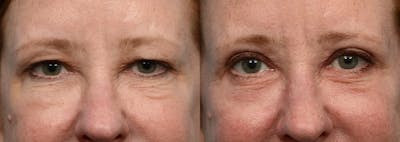 Blepharoplasty (Eyelid Surgery) Before & After Gallery - Patient 242875 - Image 1