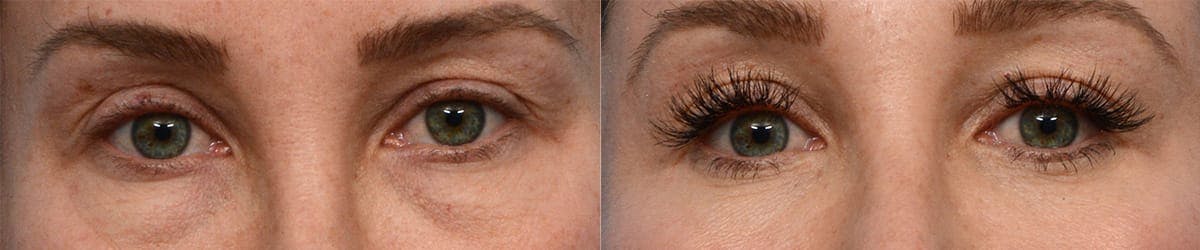 Blepharoplasty (Eyelid Surgery) Before & After Gallery - Patient 108979 - Image 1