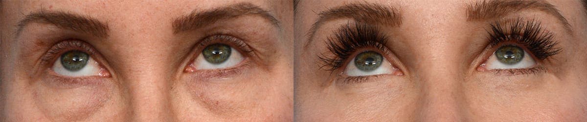 Blepharoplasty (Eyelid Surgery) Before & After Gallery - Patient 108979 - Image 2