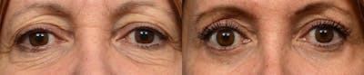 Blepharoplasty (Eyelid Surgery) Before & After Gallery - Patient 279285 - Image 1