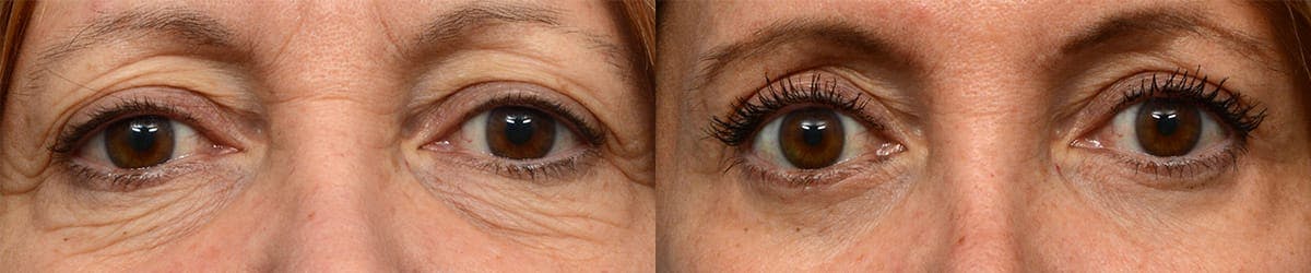 Blepharoplasty (Eyelid Surgery) Before & After Gallery - Patient 279285 - Image 1