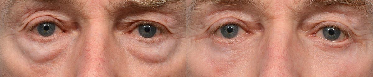 Blepharoplasty (Eyelid Surgery) Before & After Gallery - Patient 391037 - Image 1